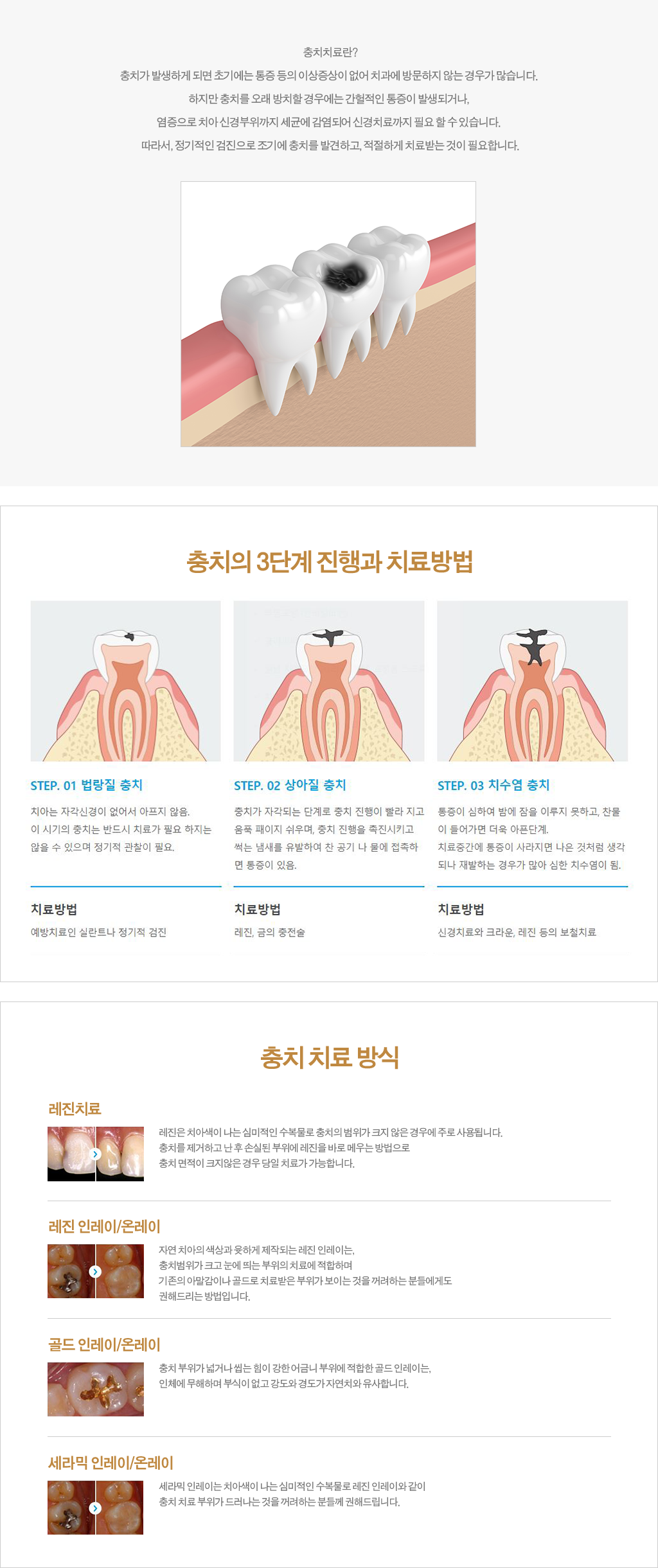 충치치료